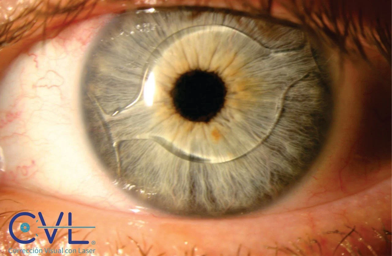 CVL Laser - Image 6