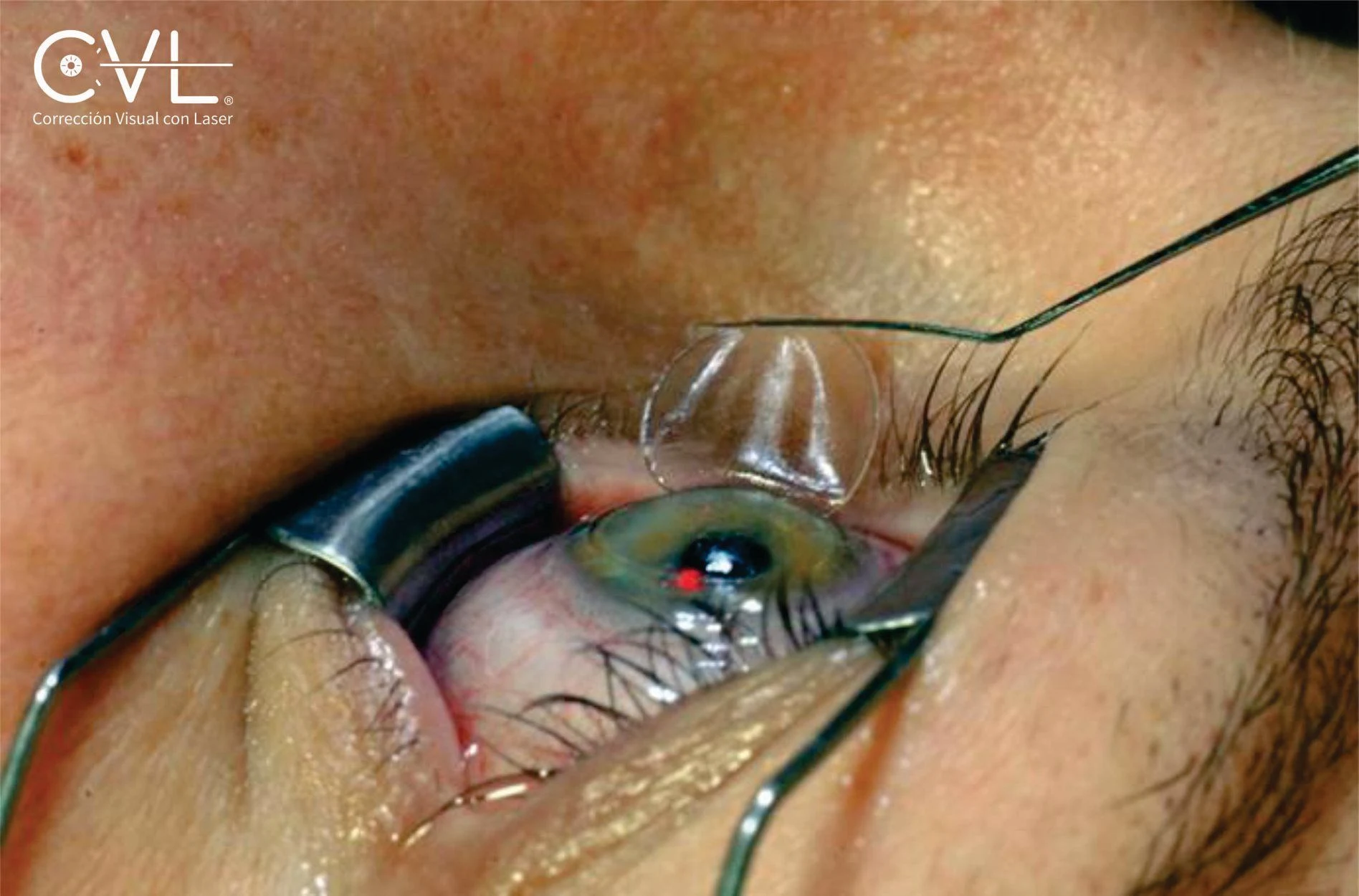 CVL Laser - Image 7